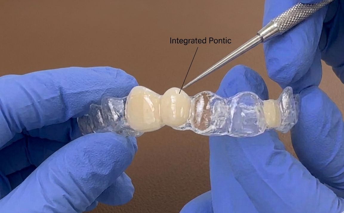 Integrated Pontic inside Aligner